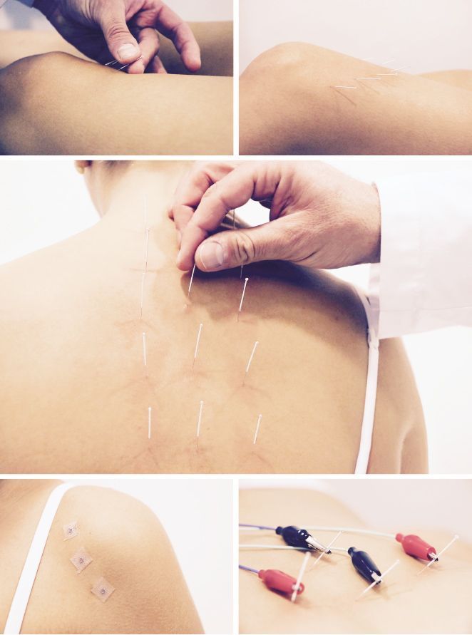 Acupuntura